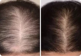 Customer shared scalp density comparison